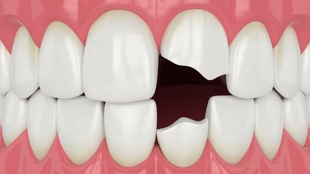 Broken Tooth Repair