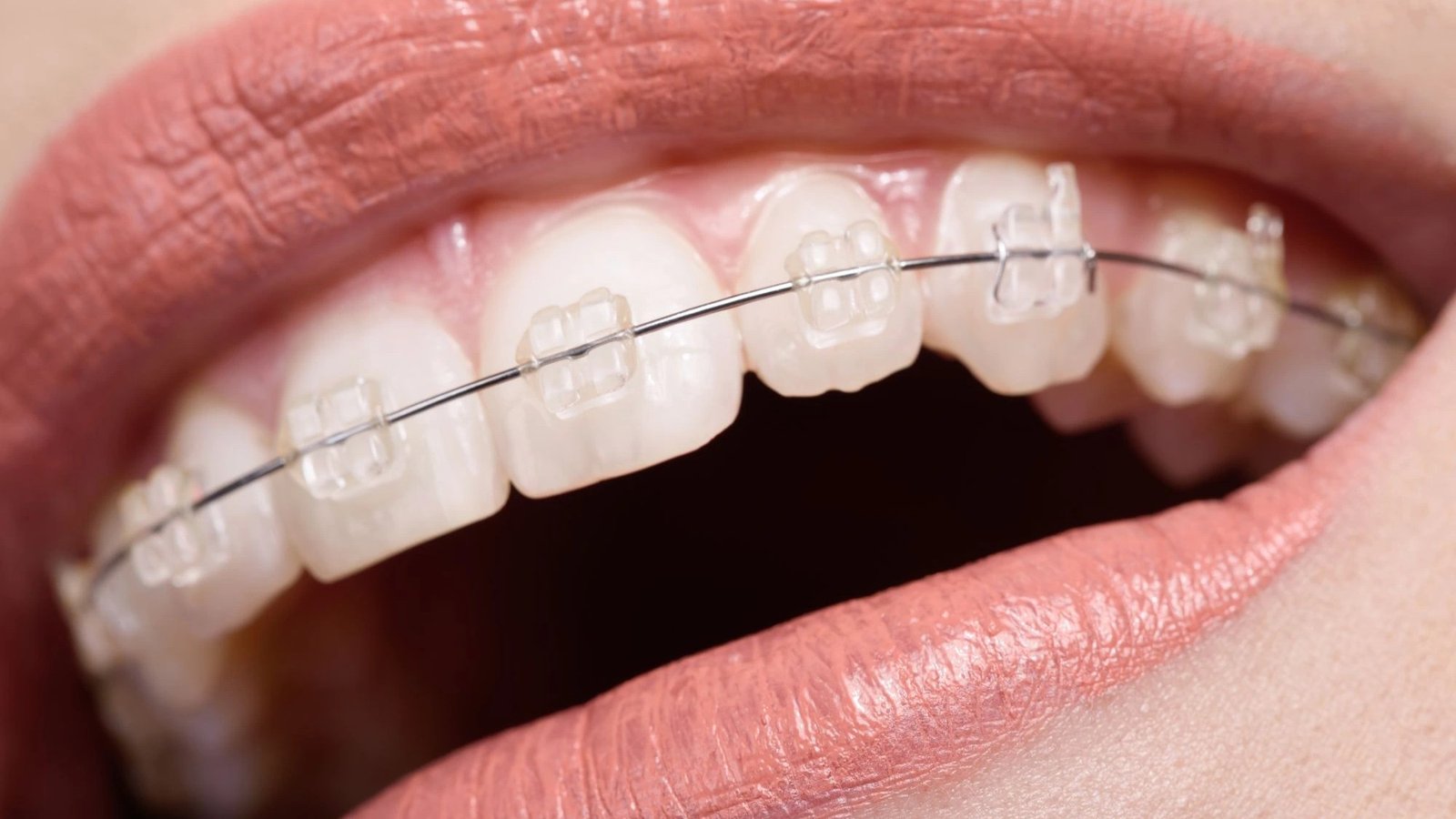 Ceramic Braces in Sector 122 Noida