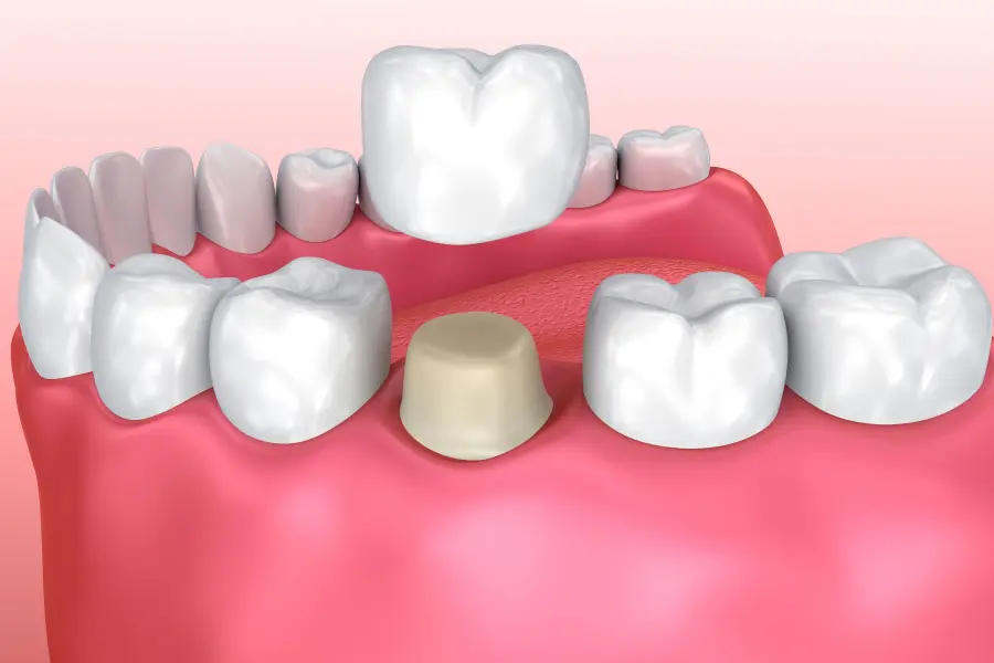 Tooth, Ceramic Crowns in Sector 122 Noida