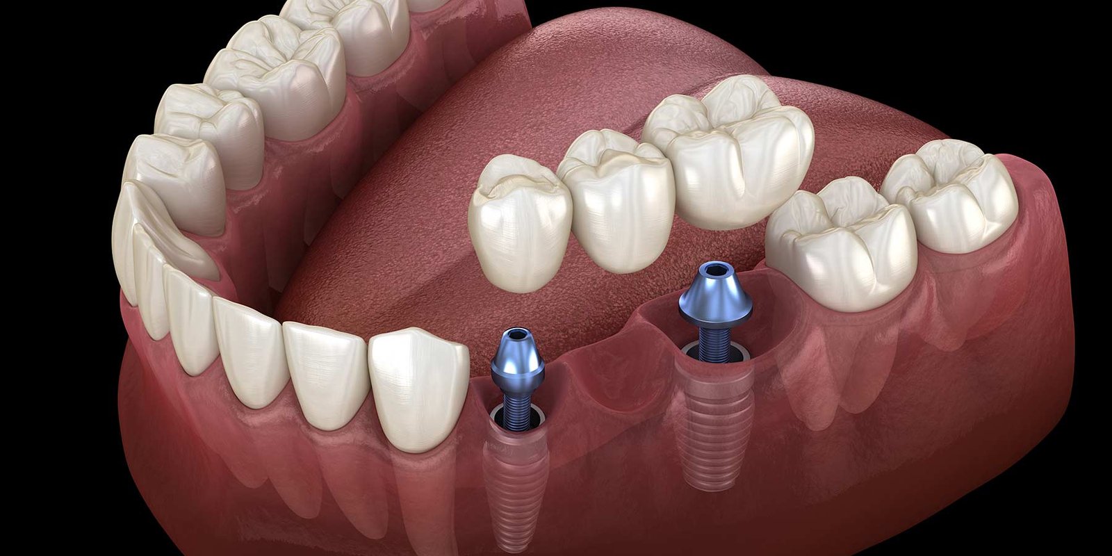 Dental Clinic Near Sector 122 Noida