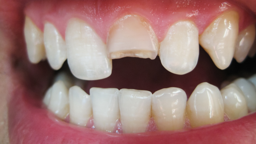 Dental Trauma