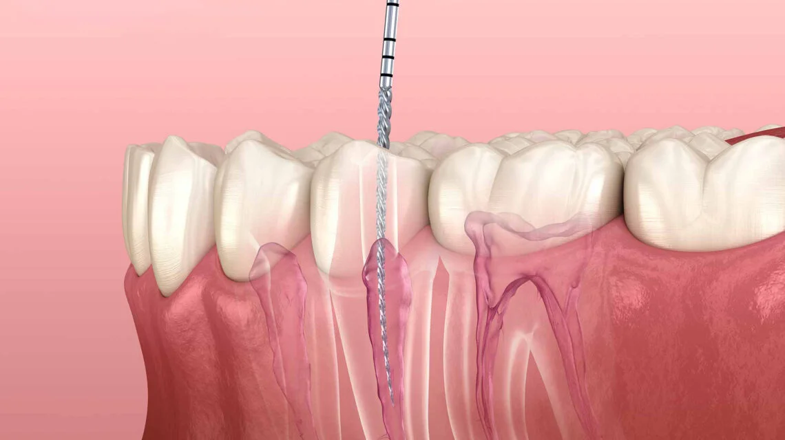 Emergency Root Canal Treatment