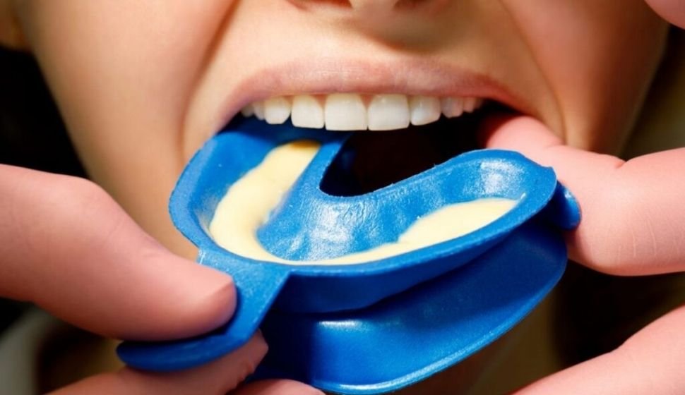 Fluoride Treatment & Sealants