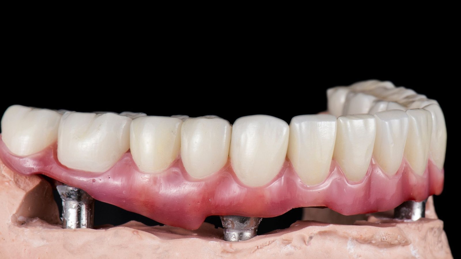 Full Mouth Implant in Sector 122 Noida