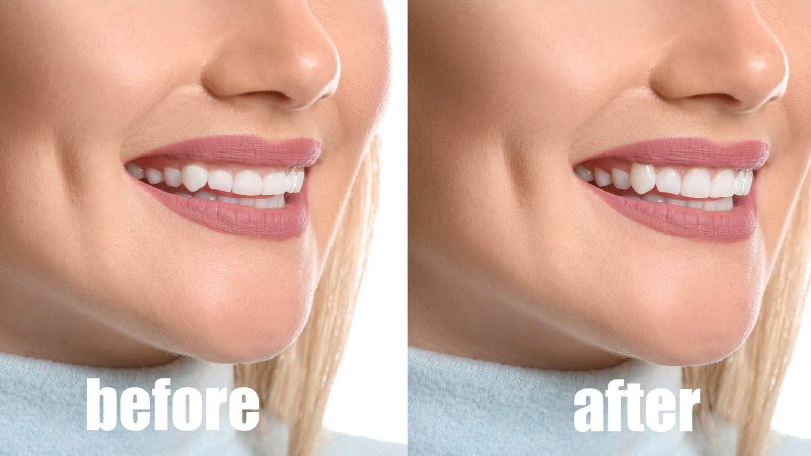 Gum Contouring