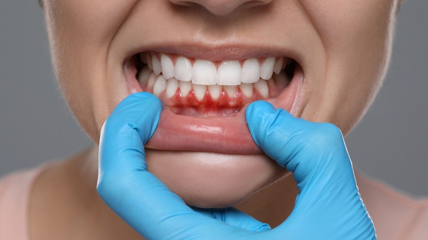 Gum Disease Treatment in Sector 122 Noida