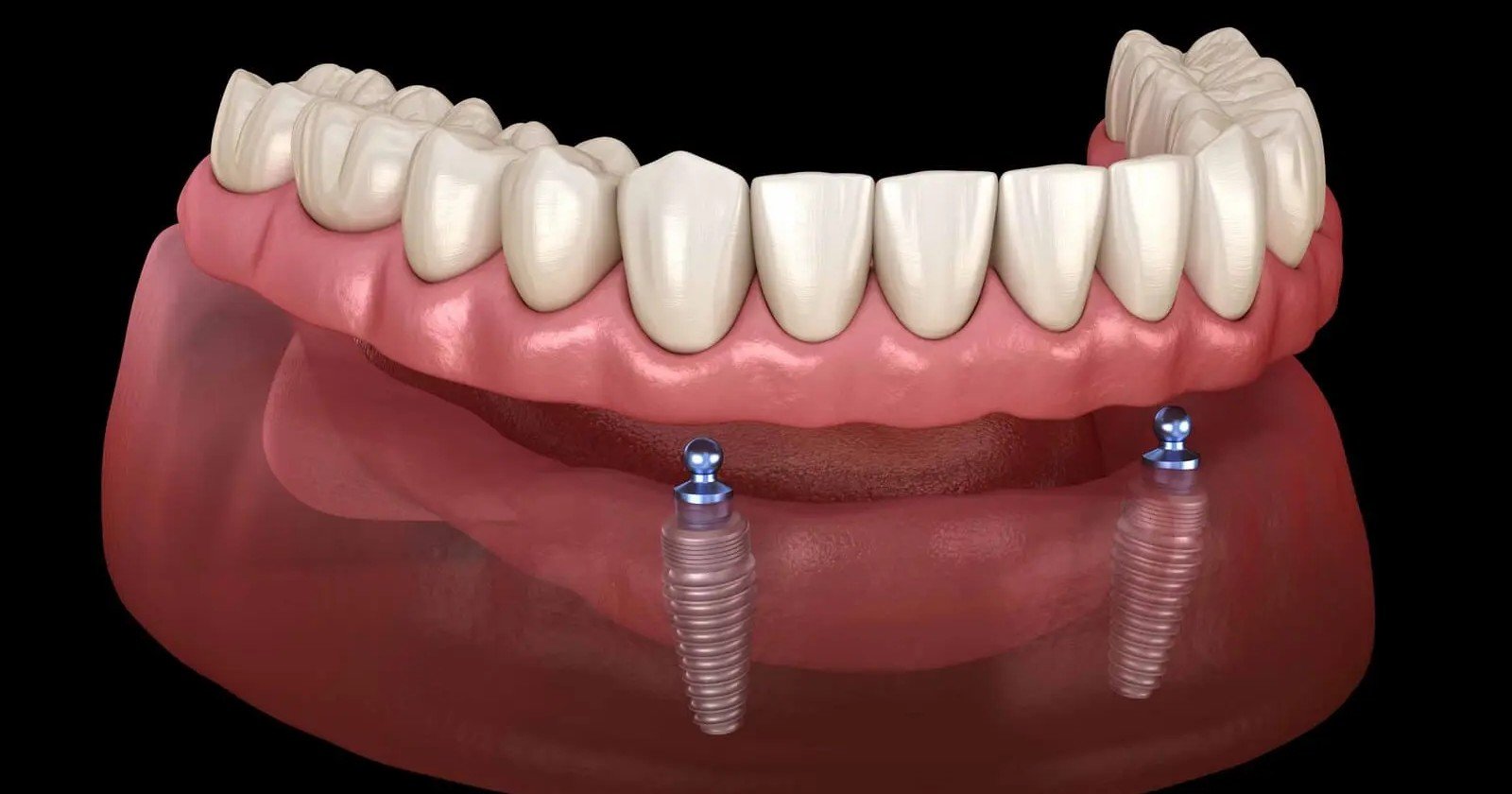 Best Dental Implant Clinic in Sector 122 Noida