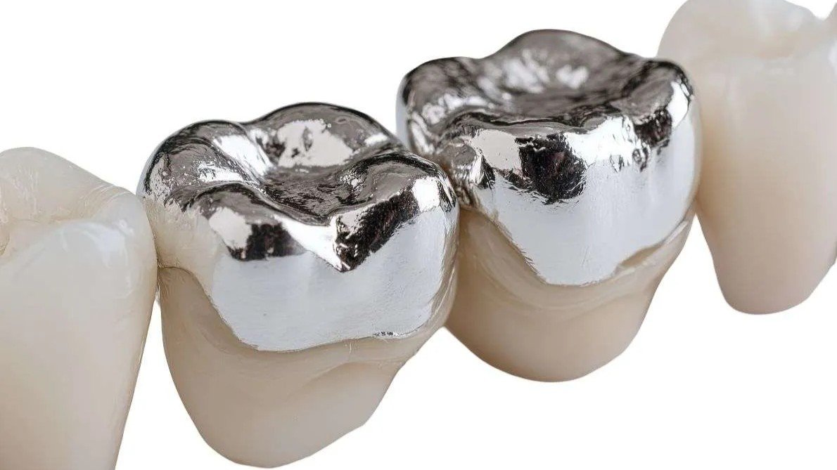 Metal Ceramic Crowns in Sector 122 Noida