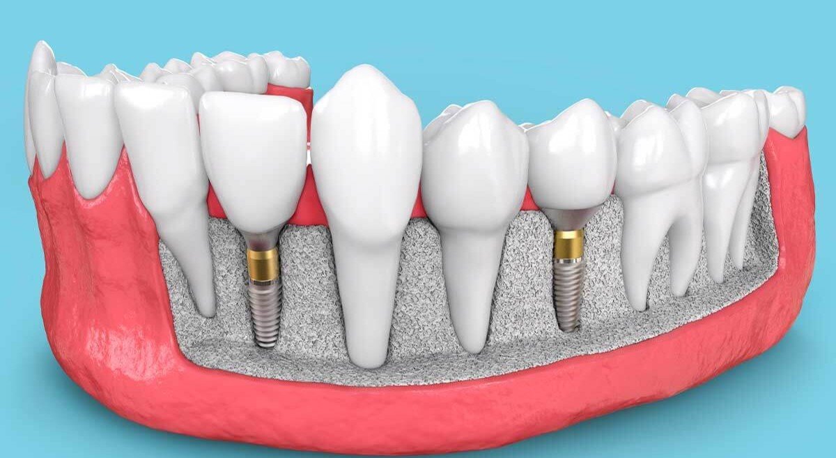 Dental Implant Specialist in Sector 122 Noida