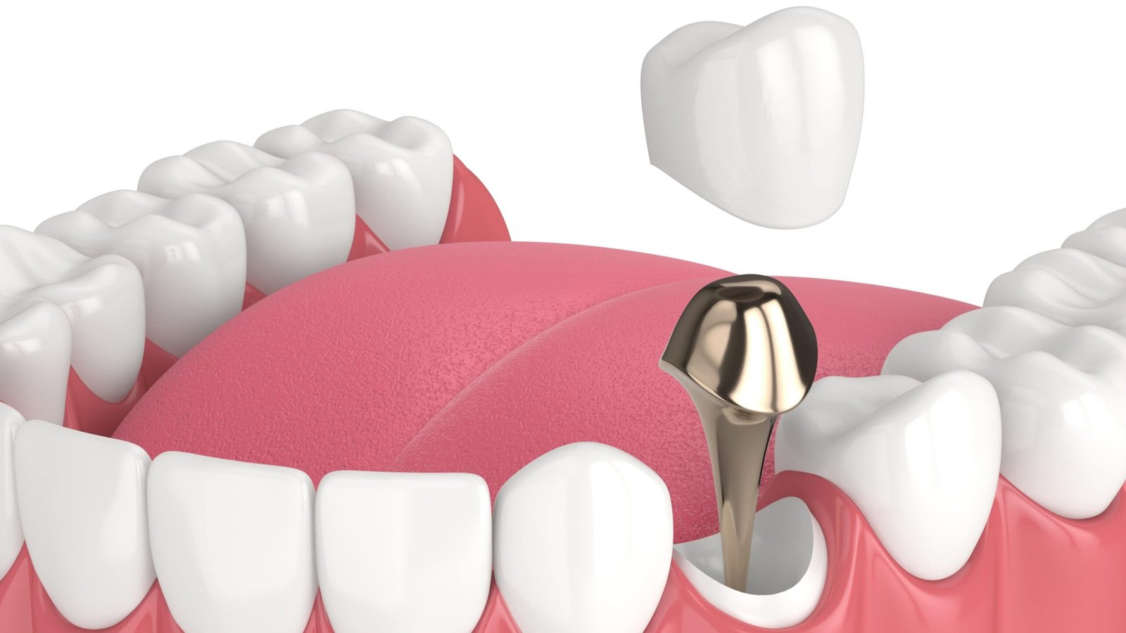 Post & Core Restorations