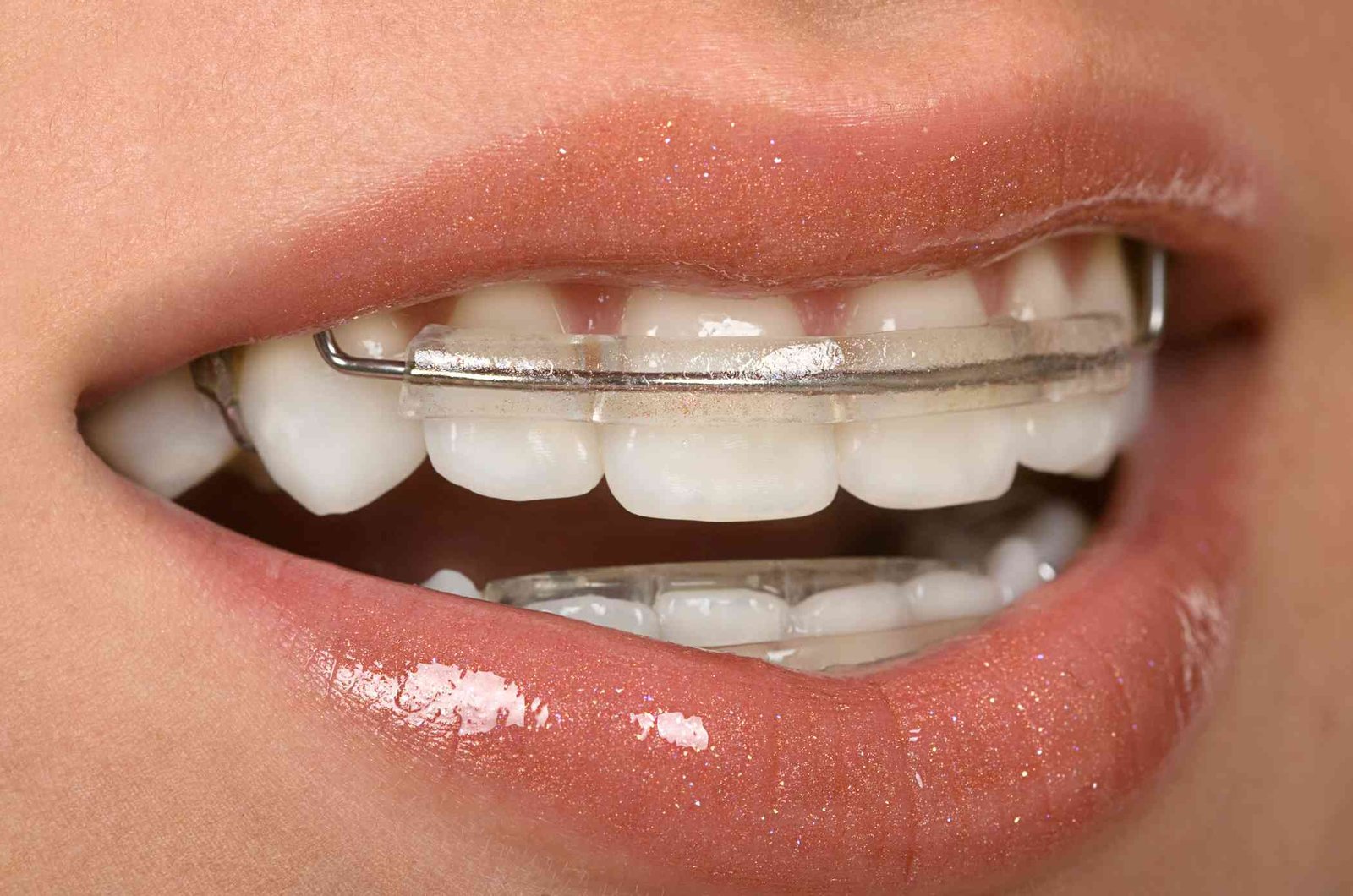 retainers