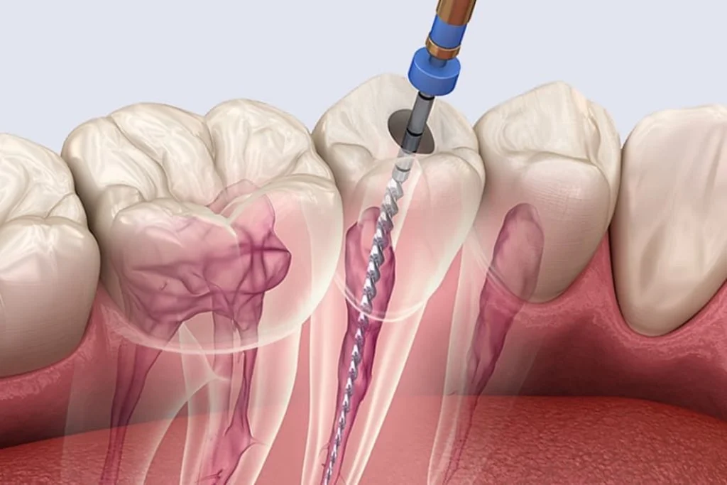 Rotary Endodontics in Sector 122 Noida