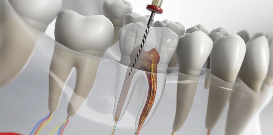 Best Root Canal Dentist in Sector 122 Noida