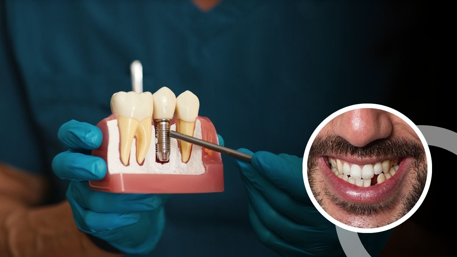 Single Tooth Implant in Sector 122 Noida
