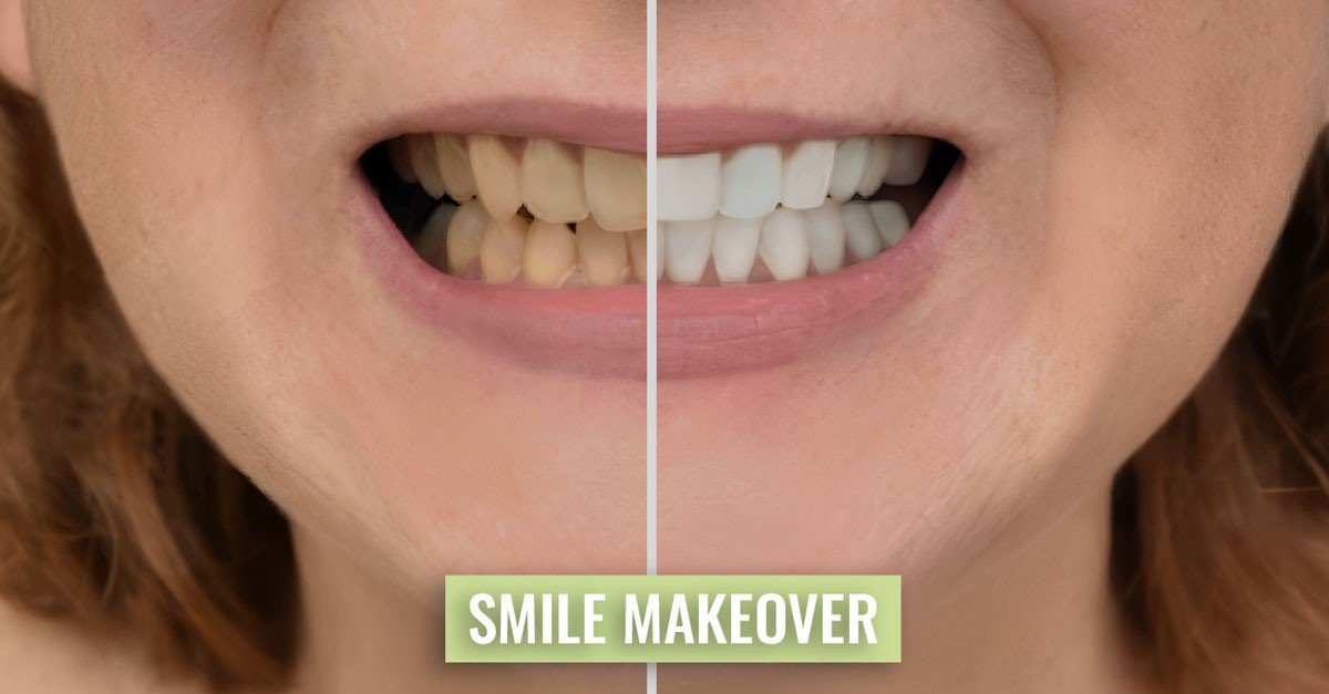 Smile Makeovers