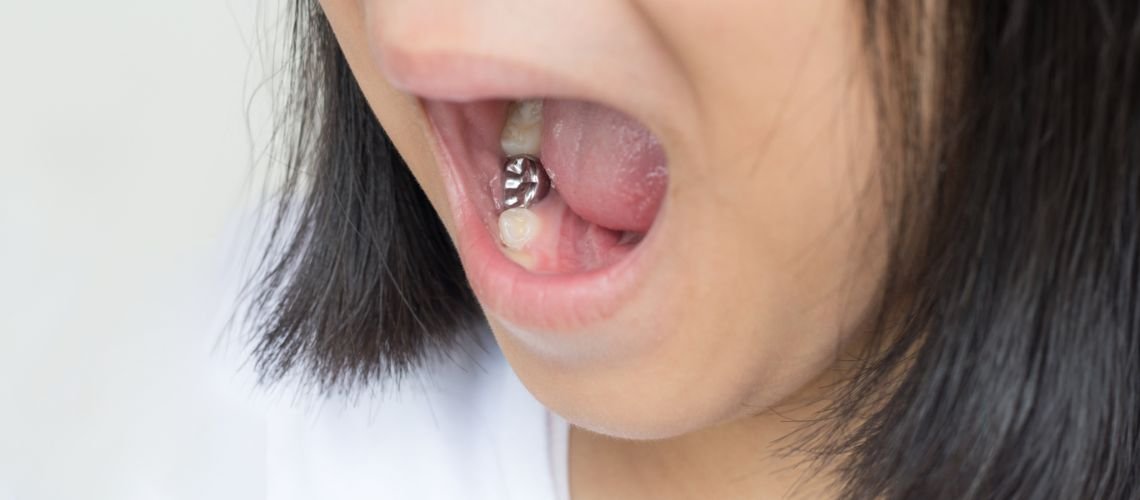 Stainless Steel Crowns for Children