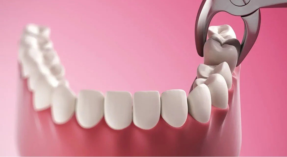 Surgical Extractions