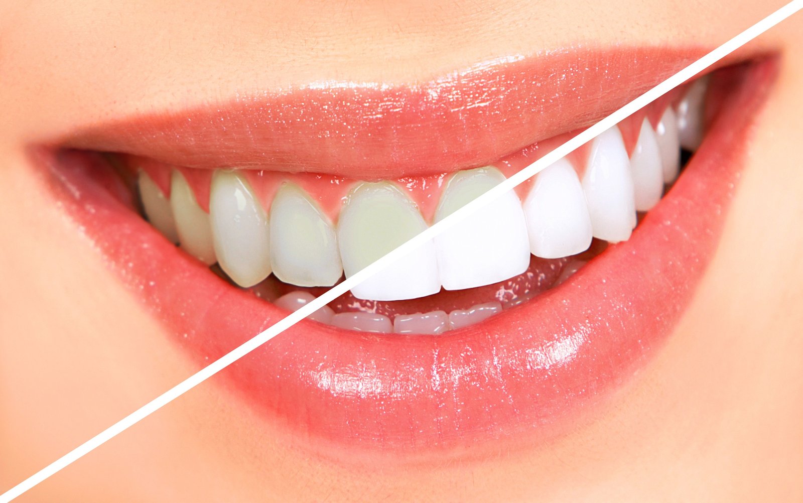 Teeth Whitening Clinic Near Sector 122 Noida