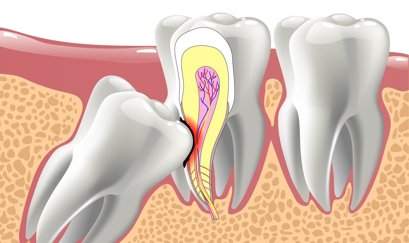Wisdom Tooth Removal in Sector 122 Noida
